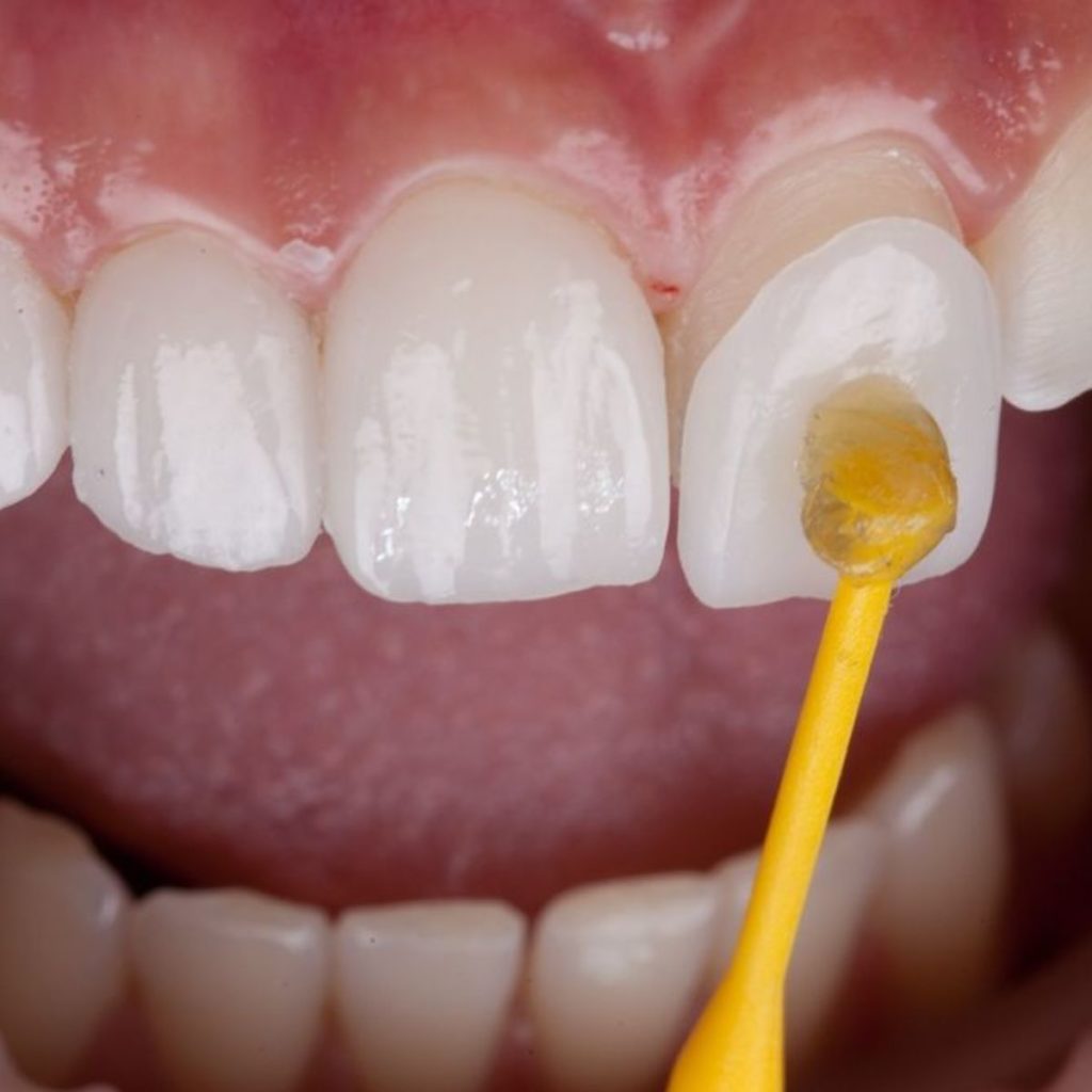 Best veneers in Dubai