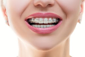 orthodontic treatment