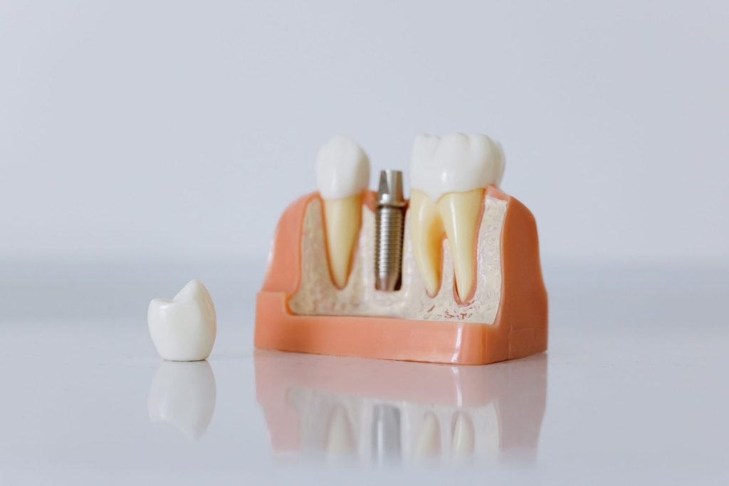 Dental implant model with artificial teeth and jaw