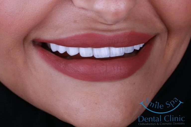 Emax Veneers