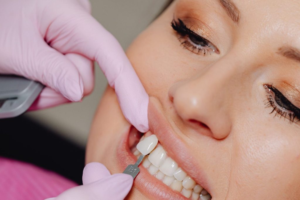 Dentist applying Emax veneers to a patient's teeth in Dubai