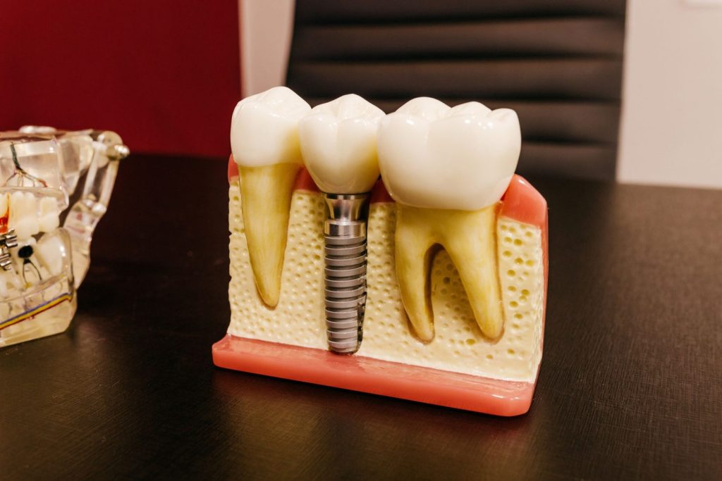 Dental implant model showing a titanium implant in the jaw