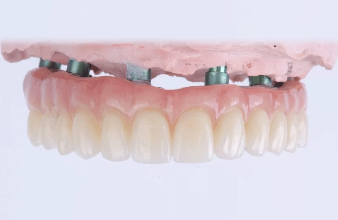 All-On-6 Replacement Teeth