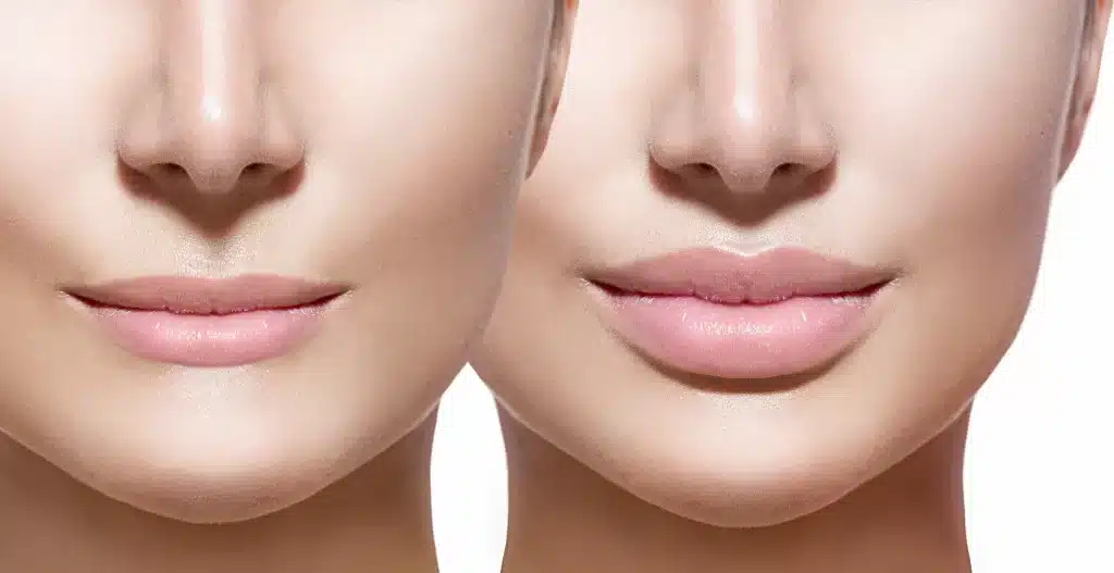 5 Benefits of Lip Fillers