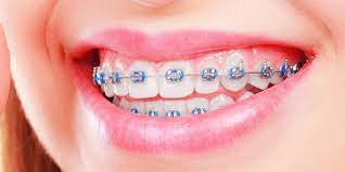 Benefits of orthodontics