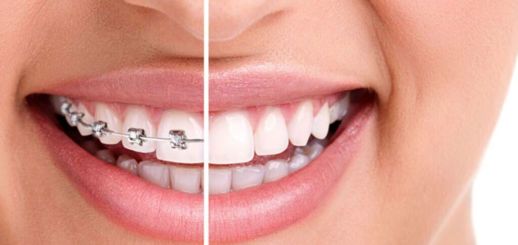 Benefits of orthodontics