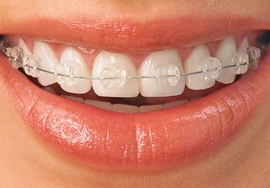 Dental Braces