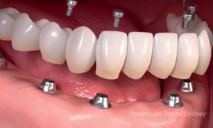 Dental implant surgery