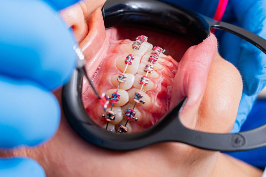 Orthodontic braces examined by a dentist during treatment