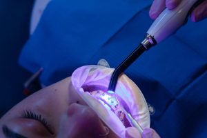 Composite bonding being cured with a dental light