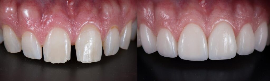 Composite Bonding 