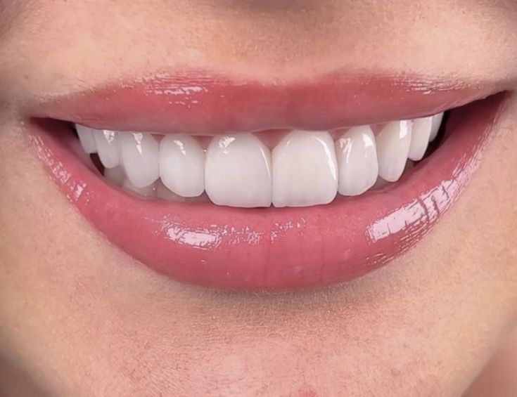 Composite Bonding 