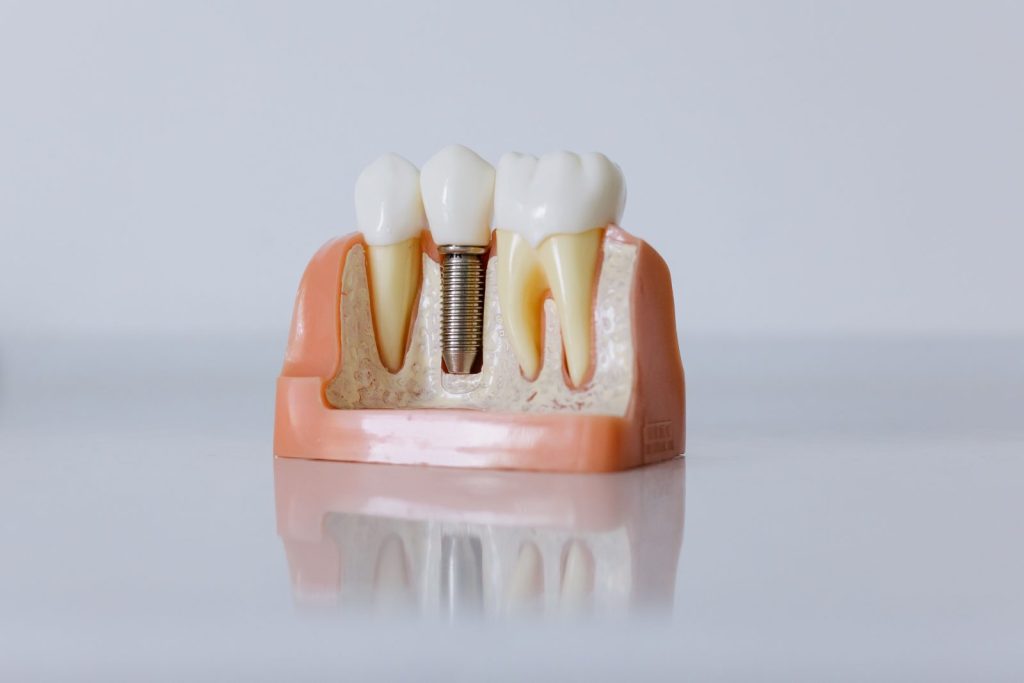 Dental implants Dubai